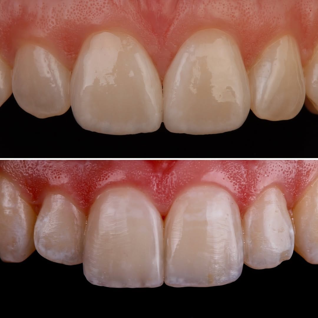 Post 8 by Dr. David K. Chan, DMD, AAACD on Instagram (carousel)