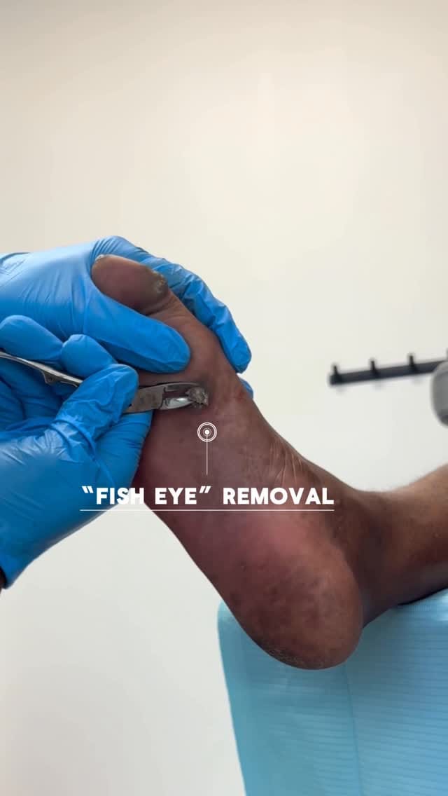 Post 5 by Dr. Jared Shipp • Podiatry on Instagram (video)