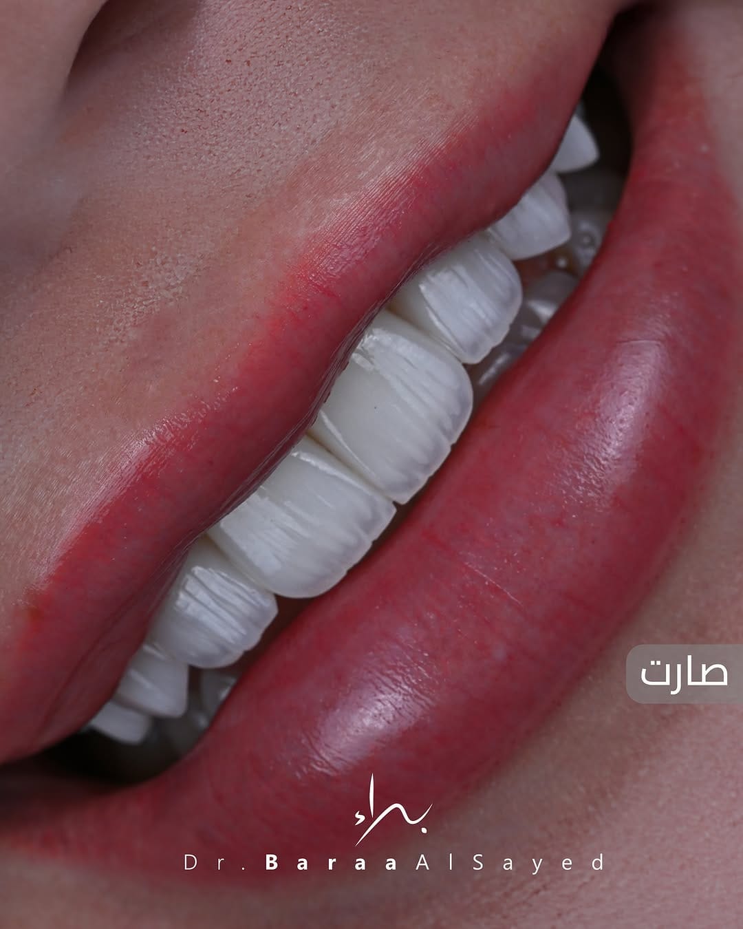 Post 9 by Baraa Al-Sayed | د.براء السيد | طبيب تجميل و زراعة الأسنان on Instagram (carousel)