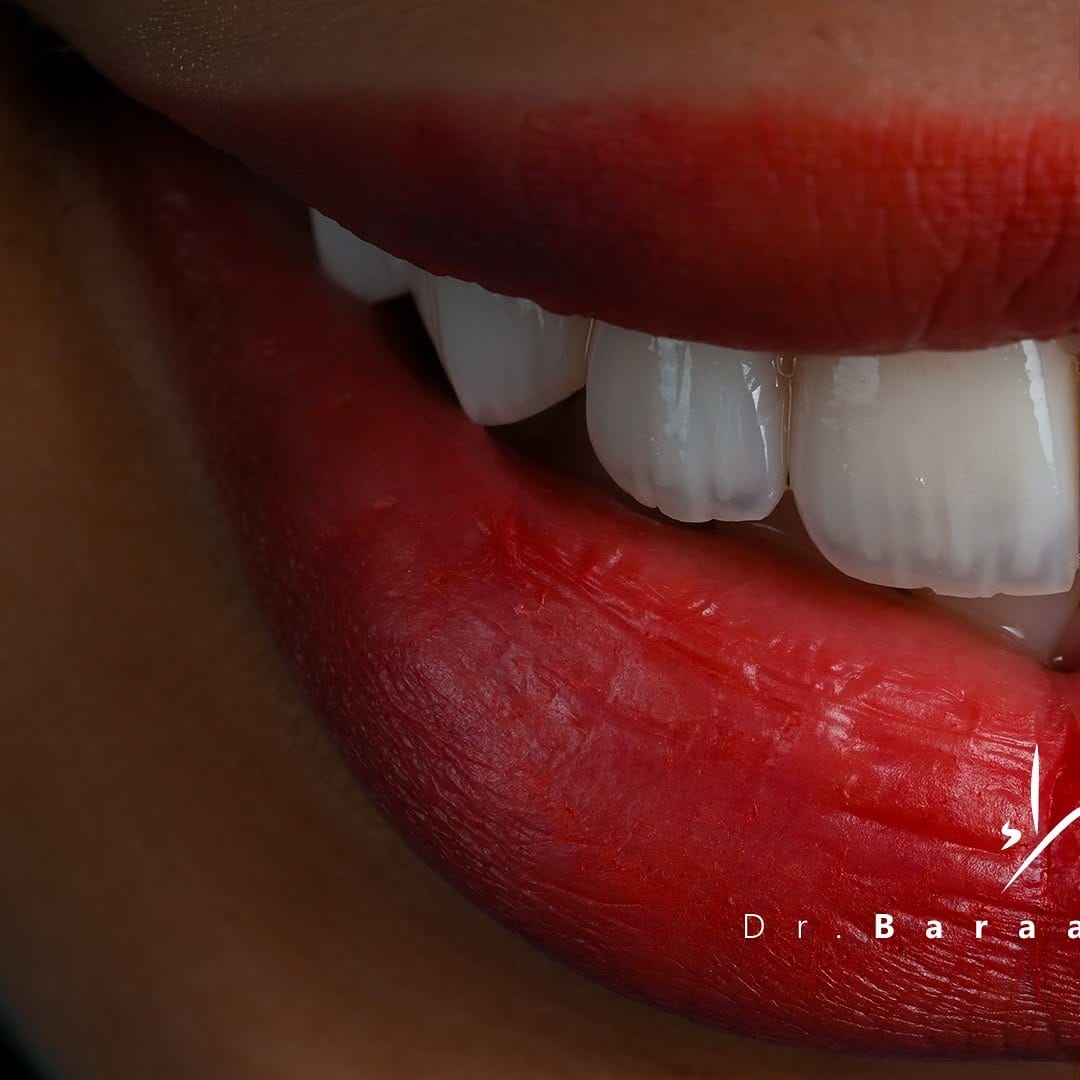 Post 10 by Baraa Al-Sayed | د.براء السيد | طبيب تجميل و زراعة الأسنان on Instagram (carousel)