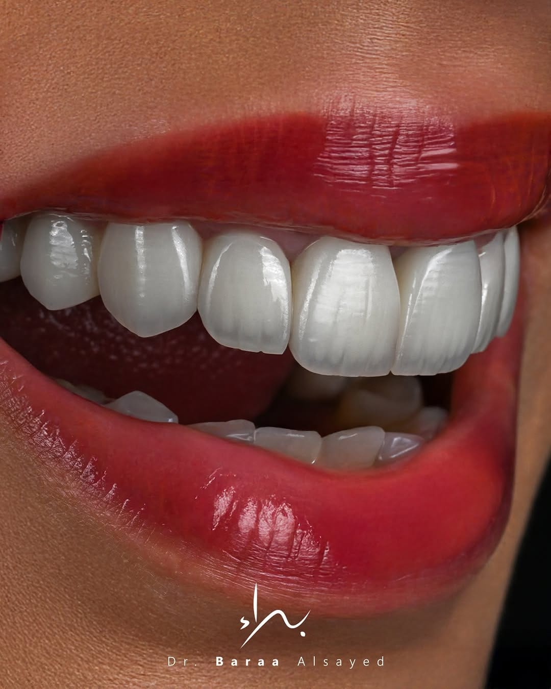 Post 4 by Baraa Al-Sayed | د.براء السيد | طبيب تجميل و زراعة الأسنان on Instagram (image)