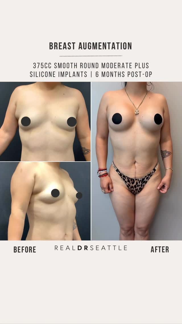 Post 4 by Javad Sajan, MD on Instagram (video)