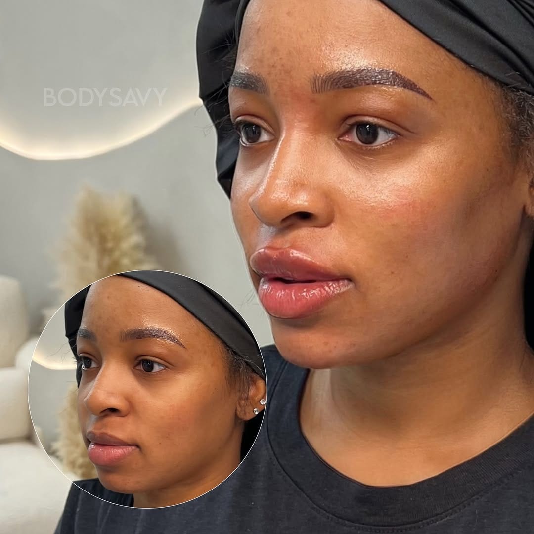 Post 2 by Atlanta Lip Fillers on Instagram (carousel)