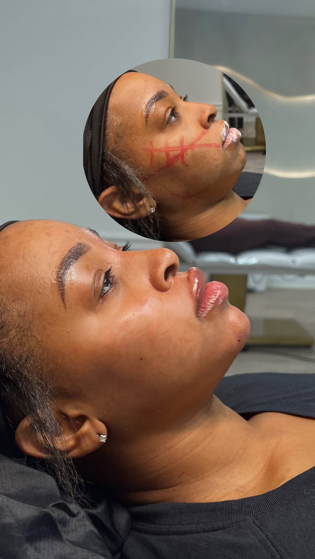 Post 1 by Atlanta Lip Fillers on Instagram (video)