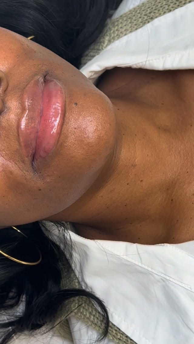 Post 8 by Atlanta Lip Fillers on Instagram (video)