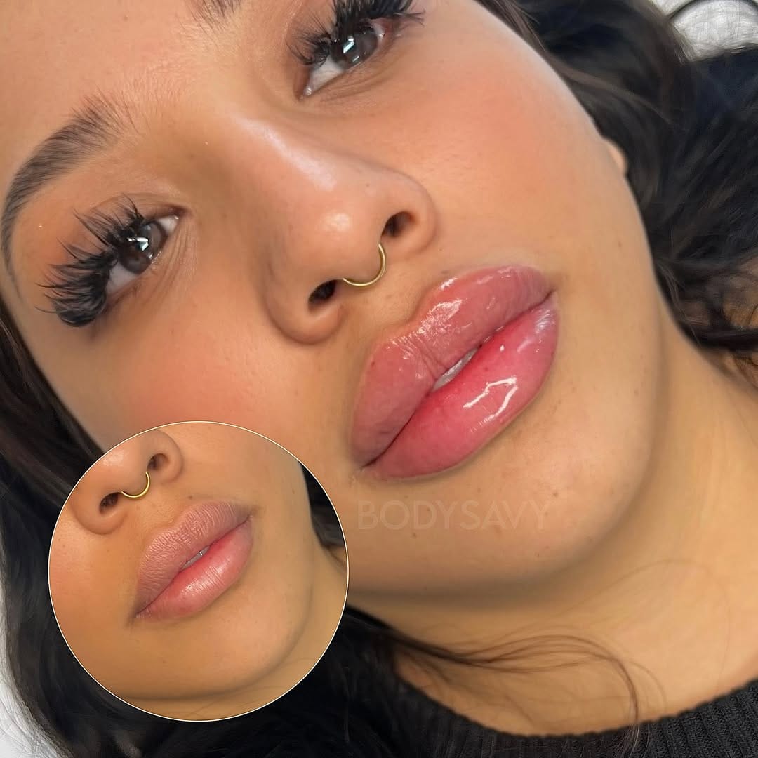Post 5 by Atlanta Lip Fillers on Instagram (image)