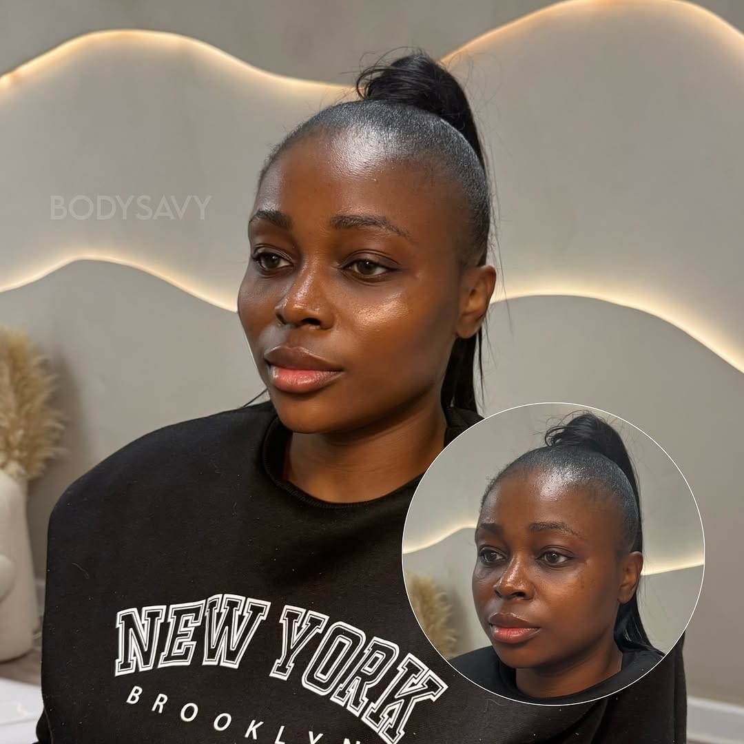 Post 9 by Atlanta Lip Fillers on Instagram (carousel)