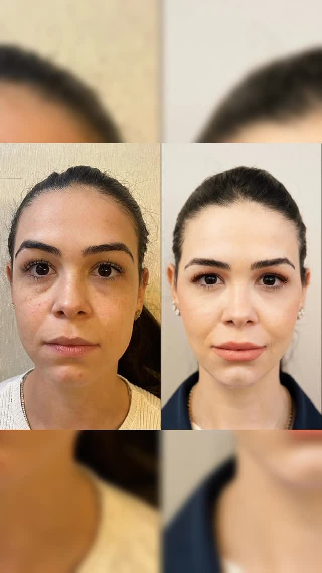 Post 9 by Simone Perini | Harmonização Facial • FULL FACE on Instagram (video)