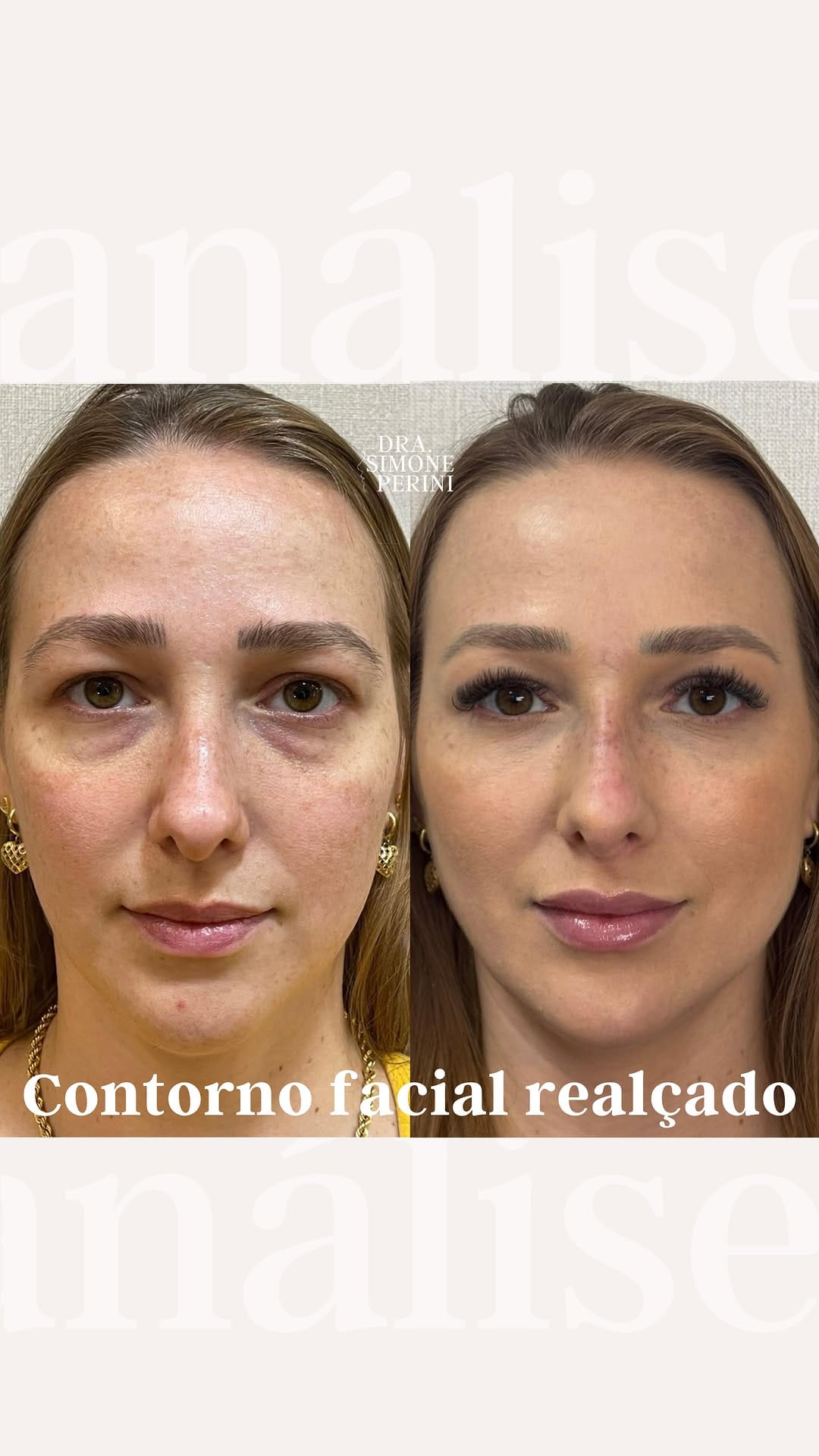 Post 10 by Simone Perini | Harmonização Facial • FULL FACE on Instagram (video)