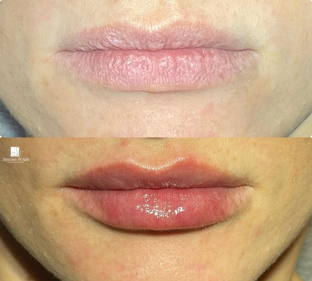 Post 7 by Simone Perini | Harmonização Facial • FULL FACE on Instagram (carousel)
