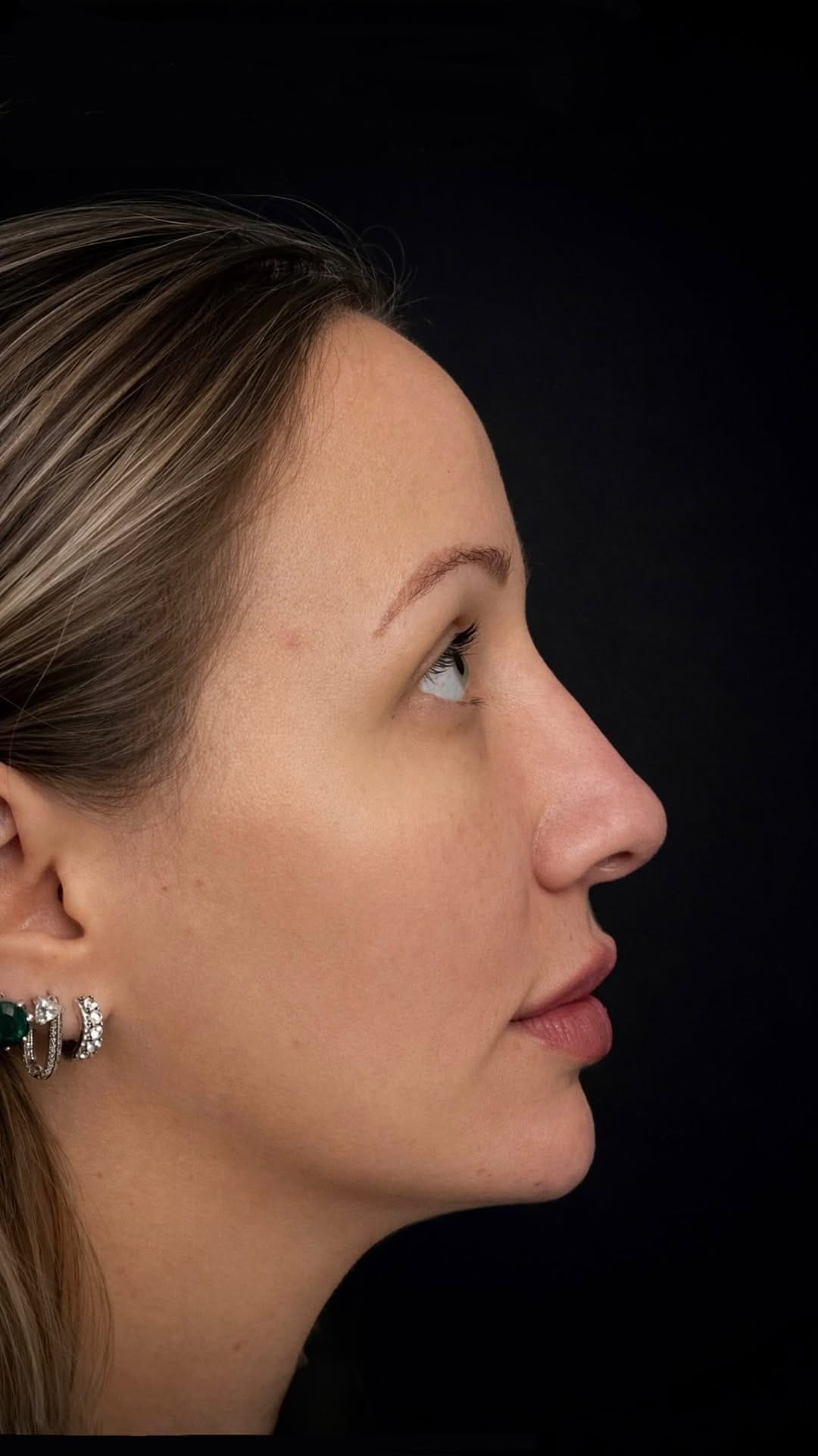 Post 8 by Simone Perini | Harmonização Facial • FULL FACE on Instagram (video)