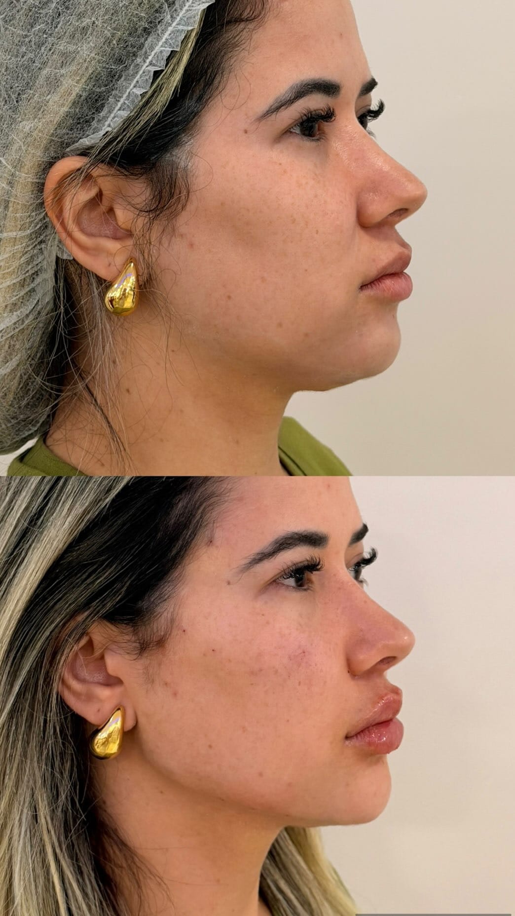 Post 3 by Simone Perini | Harmonização Facial • FULL FACE on Instagram (video)
