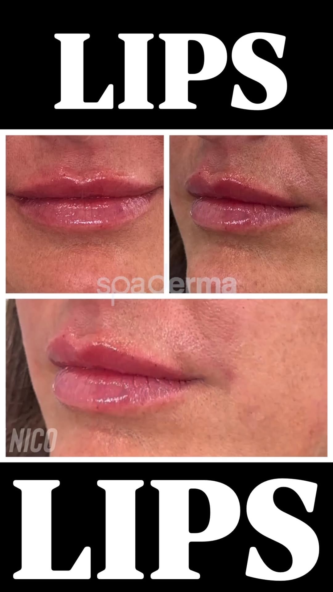 Post 8 by Nico Palanti | Aesthetic Nurse on Instagram (video)