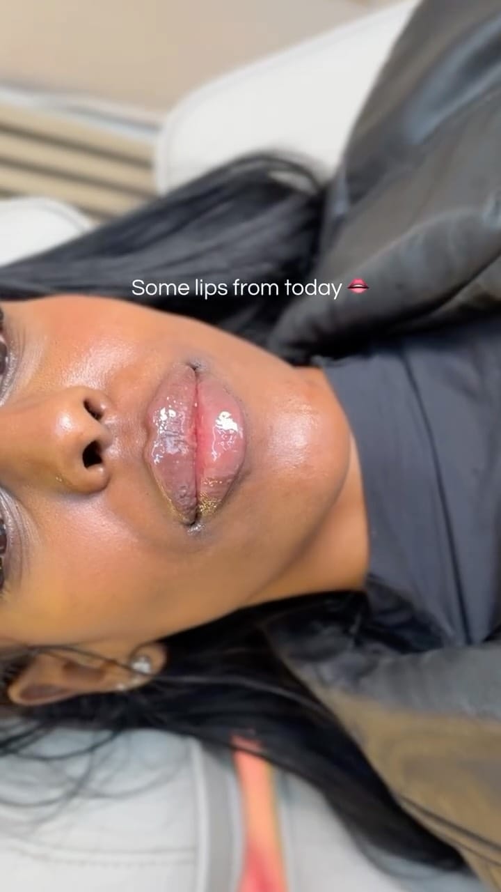 Post 6 by Nurse Lexi 🩺 Philadelphia Med Spa on Instagram (video)