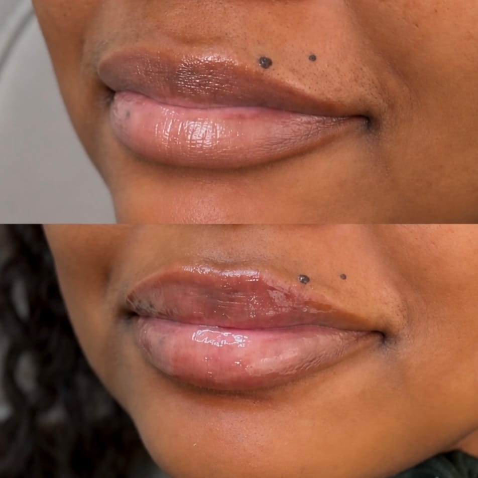 Post 5 by Nurse Lexi 🩺 Philadelphia Med Spa on Instagram (image)