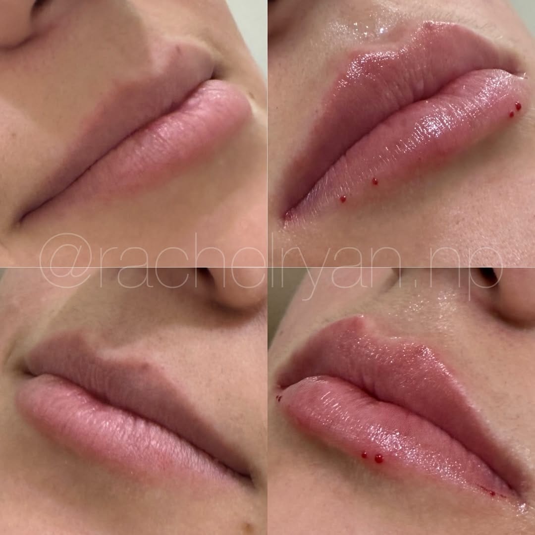 Post 1 by Rachel Ryan | FNP-C | MedSpa Boise on Instagram (image)