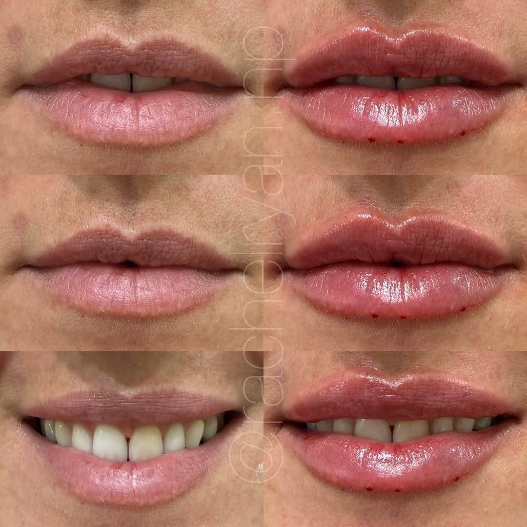 Post 4 by Rachel Ryan | FNP-C | MedSpa Boise on Instagram (image)