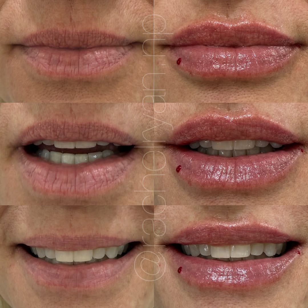 Post 6 by Rachel Ryan | FNP-C | MedSpa Boise on Instagram (image)