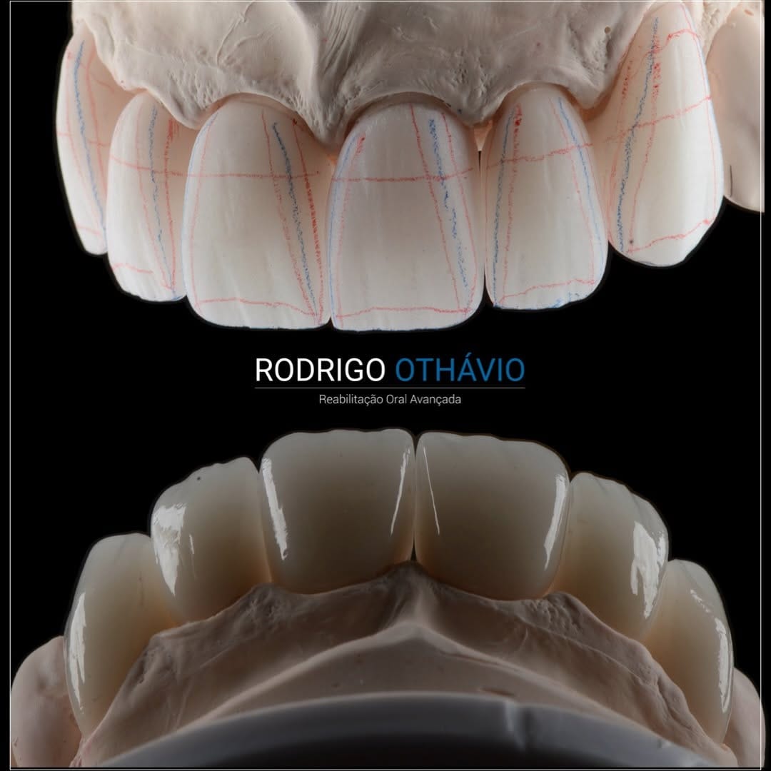 Post 1 by Dr. Rodrigo Othávio - Esp. em Reabilitação Oral on Instagram (carousel)