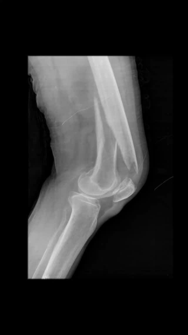 Post 4 by Dr. Pablo Vallejo Y on Instagram (video)