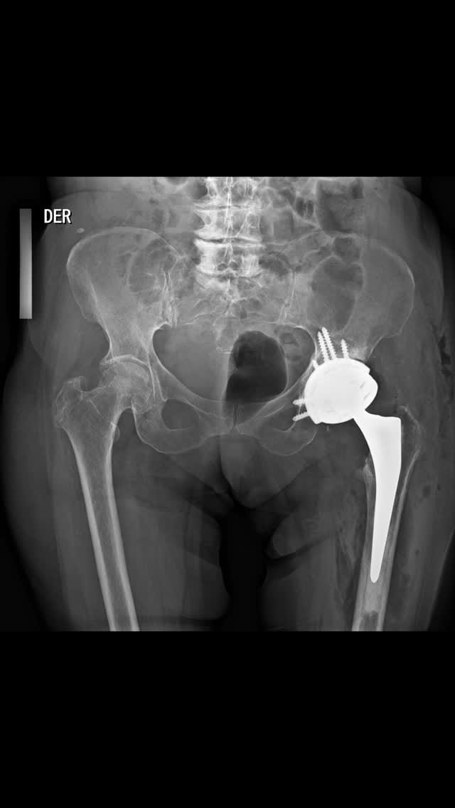 Post 6 by Dr. Pablo Vallejo Y on Instagram (video)