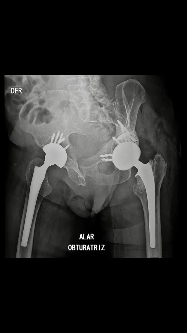 Post 1 by Dr. Pablo Vallejo Y on Instagram (video)