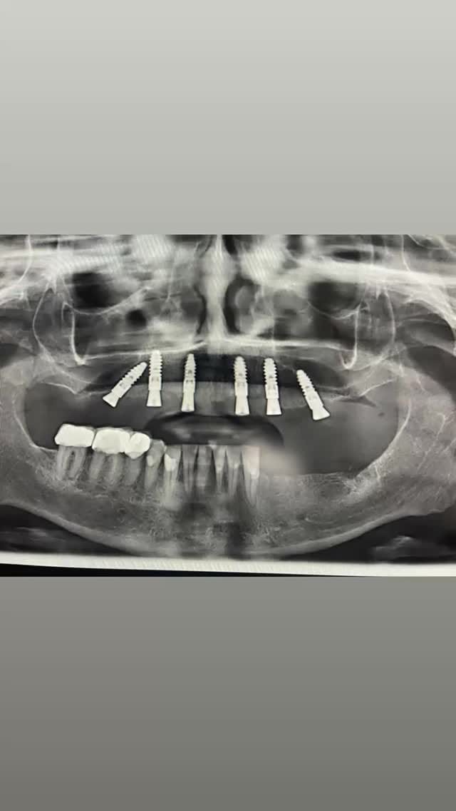 Post 4 by Dr. med. dent. Hayim M.Sc M.Sc on Instagram (video)