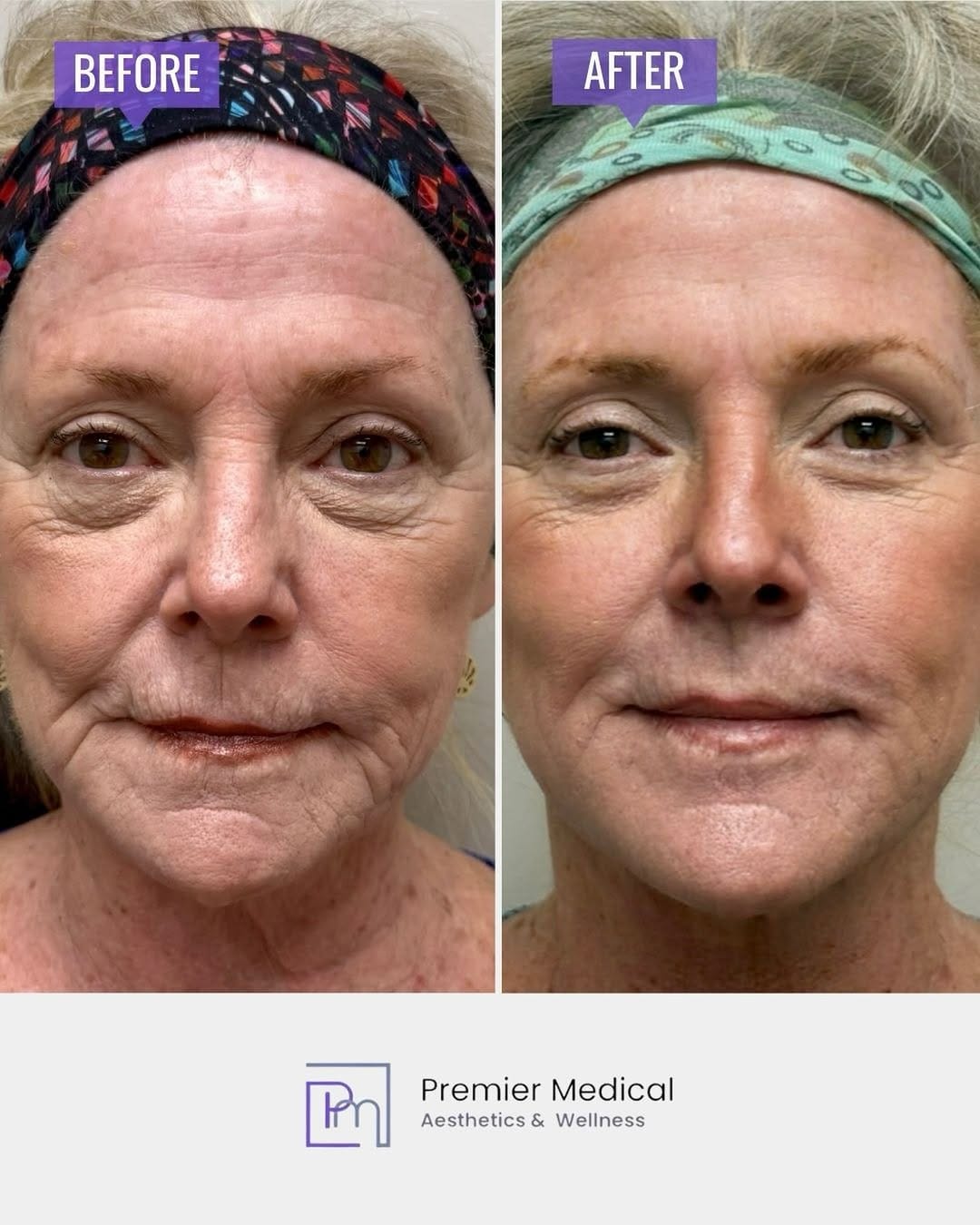 Post 9 by Premier Medical Aesthetics | Medspa | CT on Instagram (image)