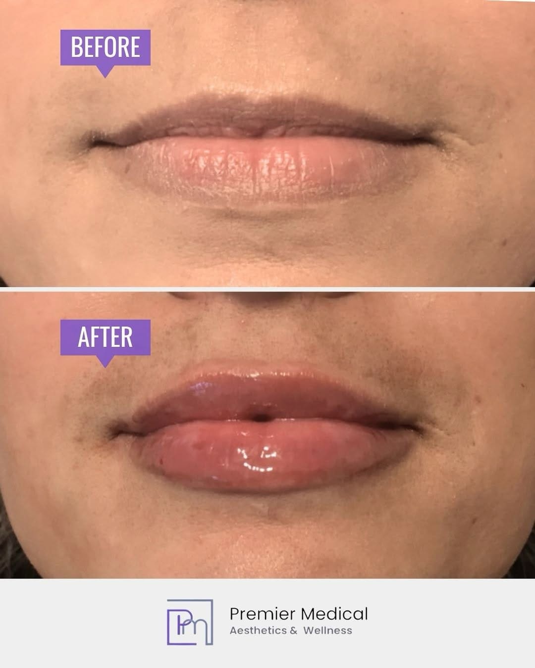 Post 1 by Premier Medical Aesthetics | Medspa | CT on Instagram (image)