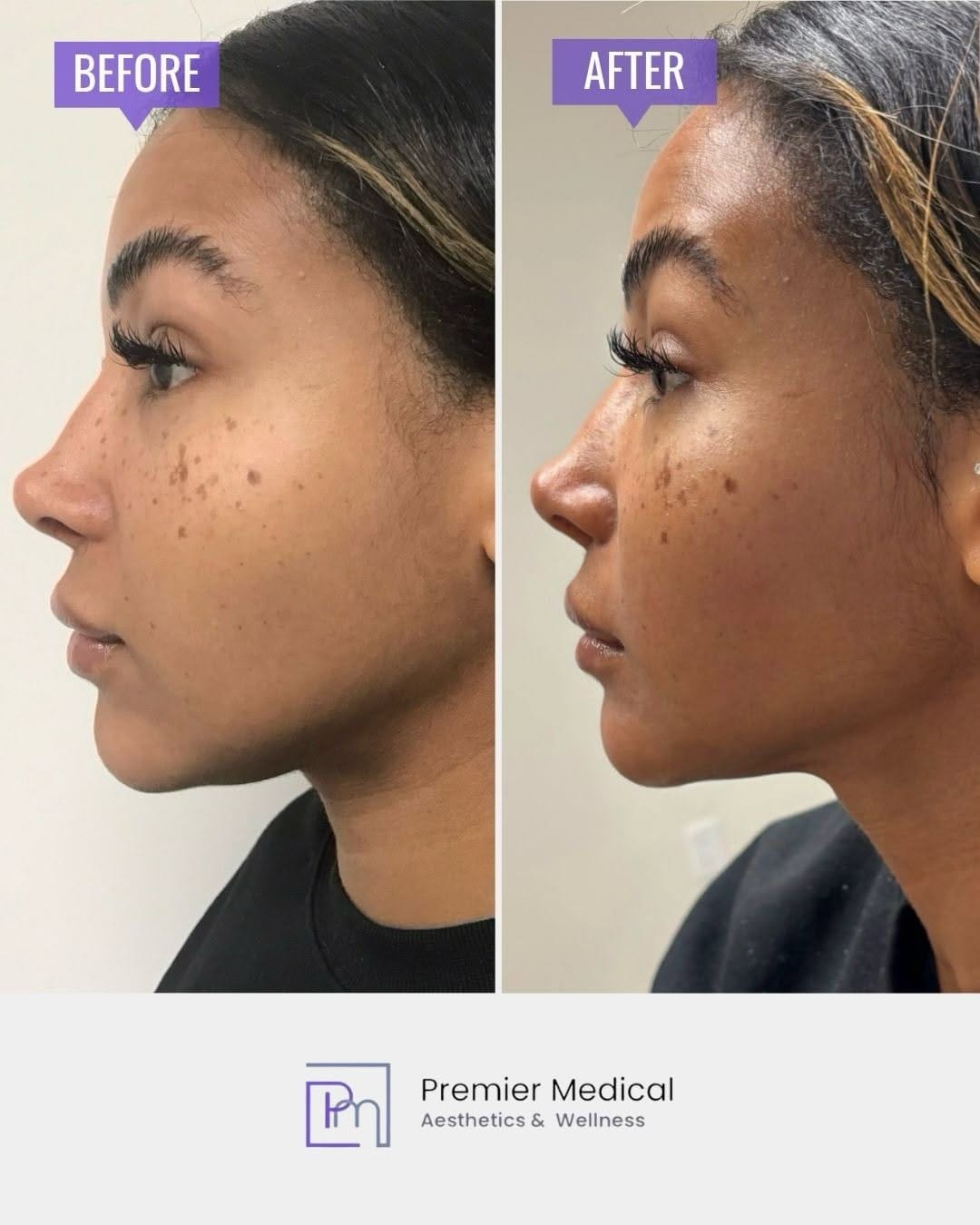 Post 4 by Premier Medical Aesthetics | Medspa | CT on Instagram (carousel)