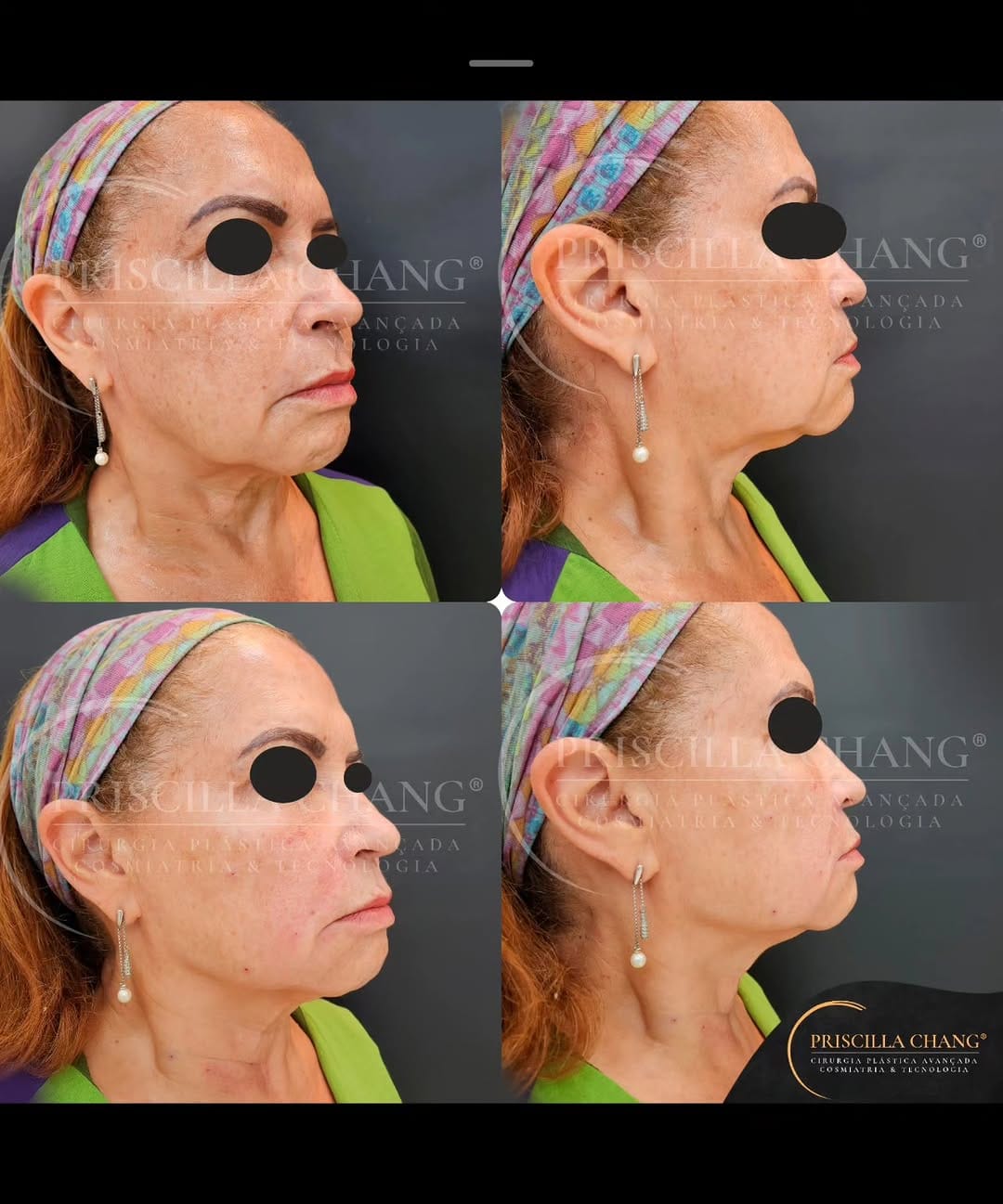 Post 10 by Lipo HD UGRAFT | Mama R24R | Priscilla Chang | Plástica | Manaus on Instagram (image)
