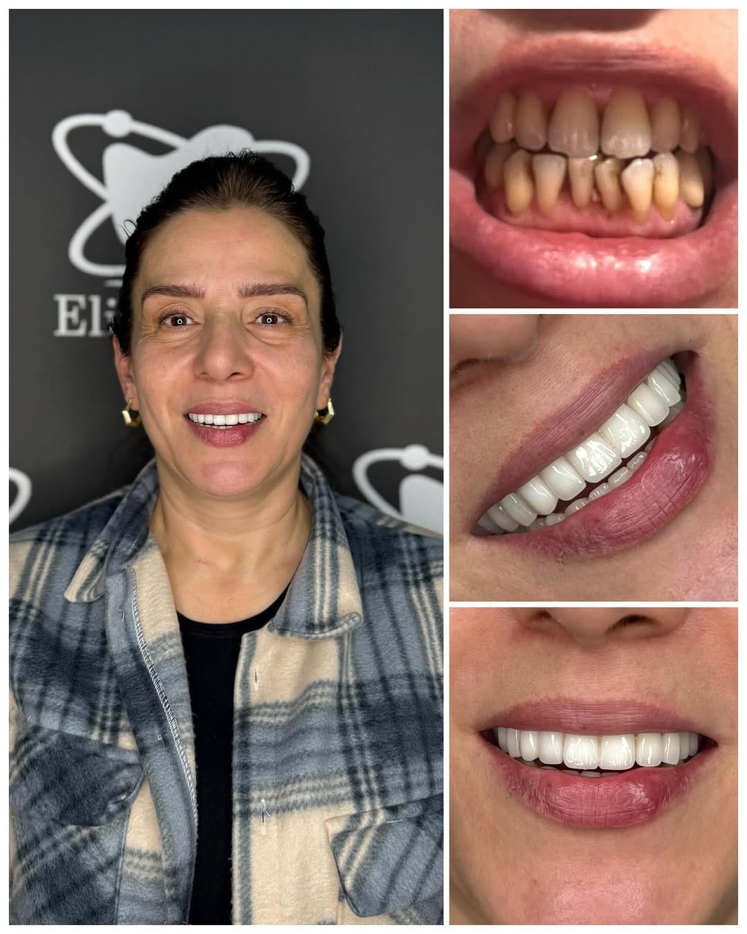 Post 4 by Elit Dental Türkiye on Instagram (image)
