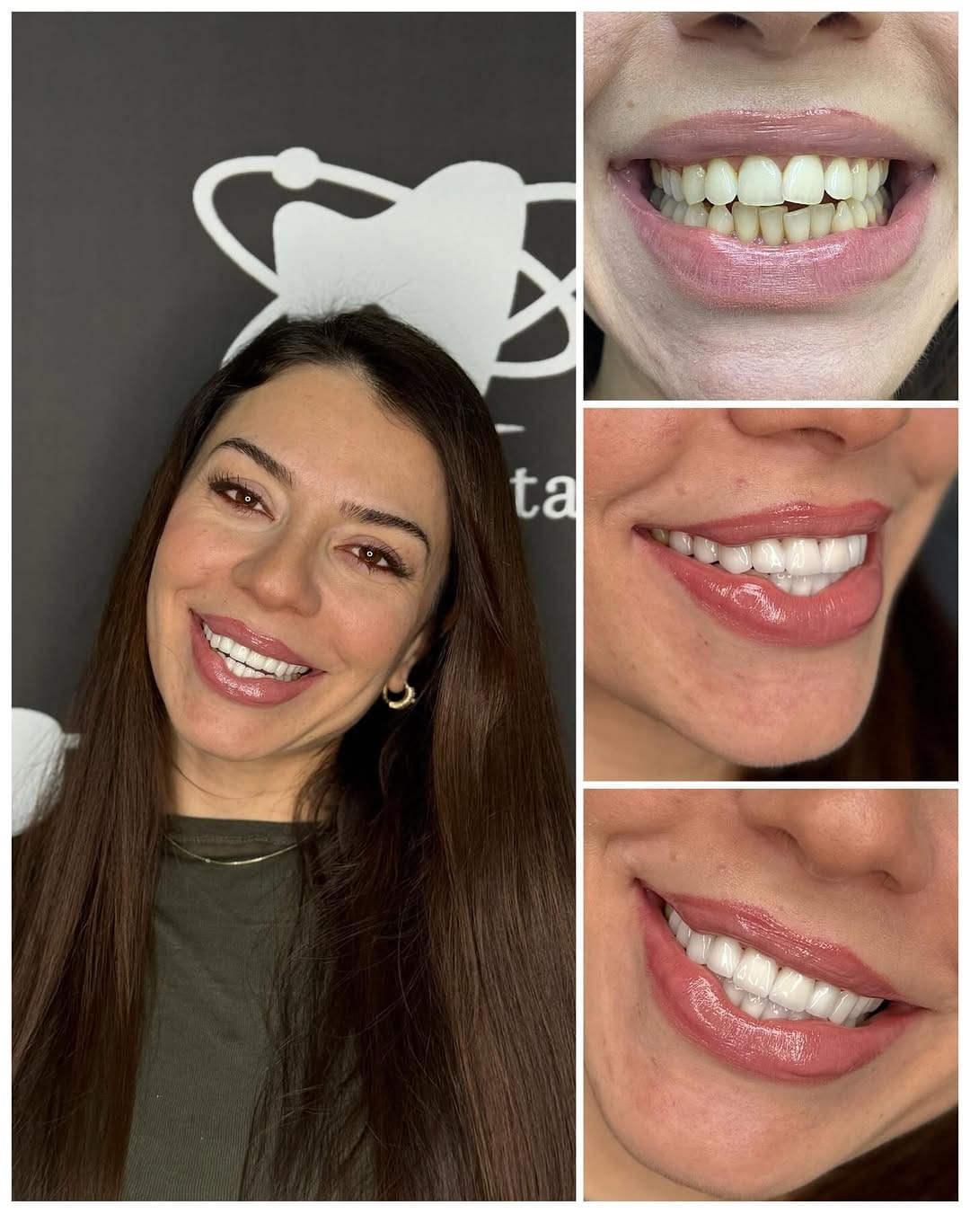 Post 5 by Elit Dental Türkiye on Instagram (image)