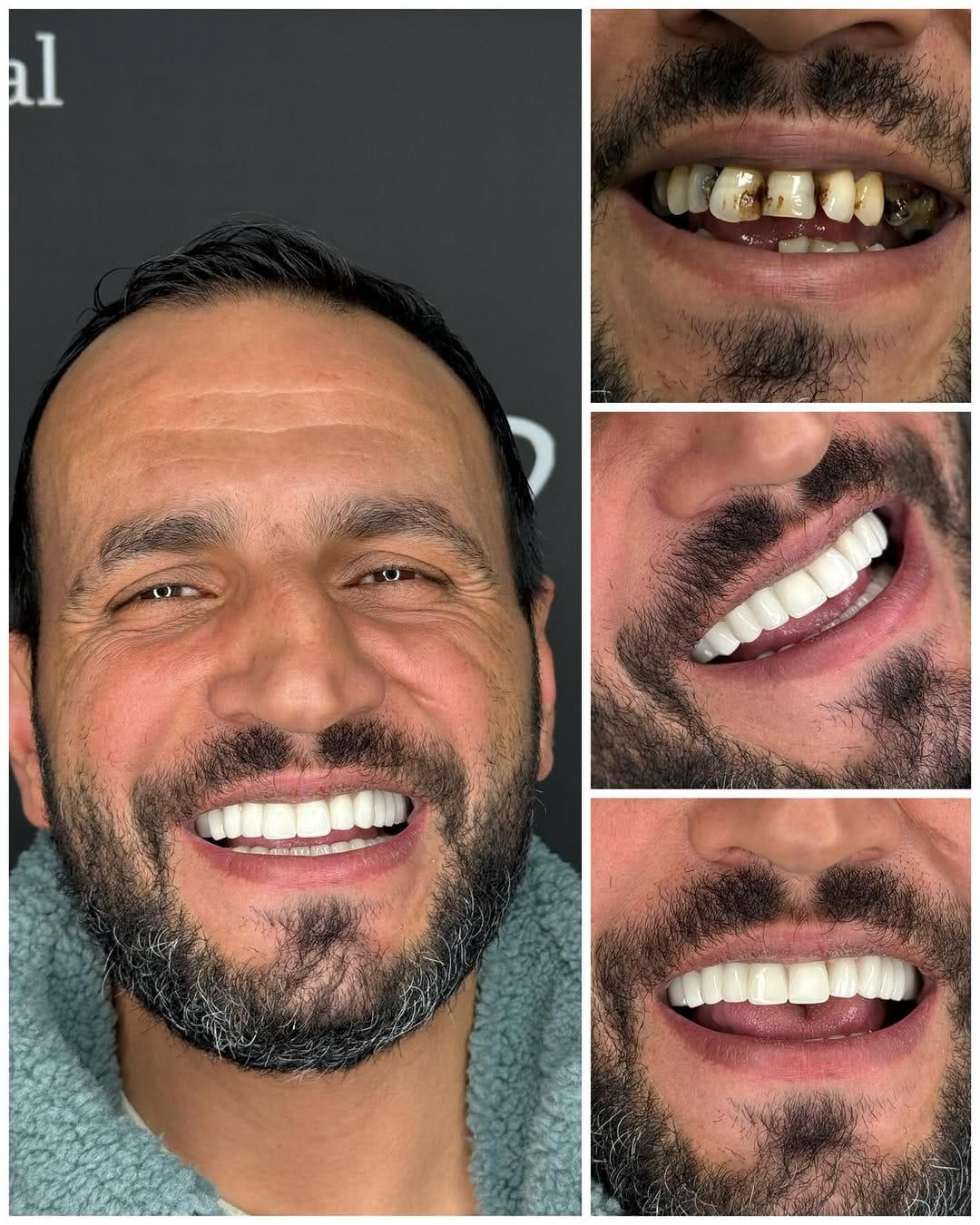 Post 1 by Elit Dental Türkiye on Instagram (image)