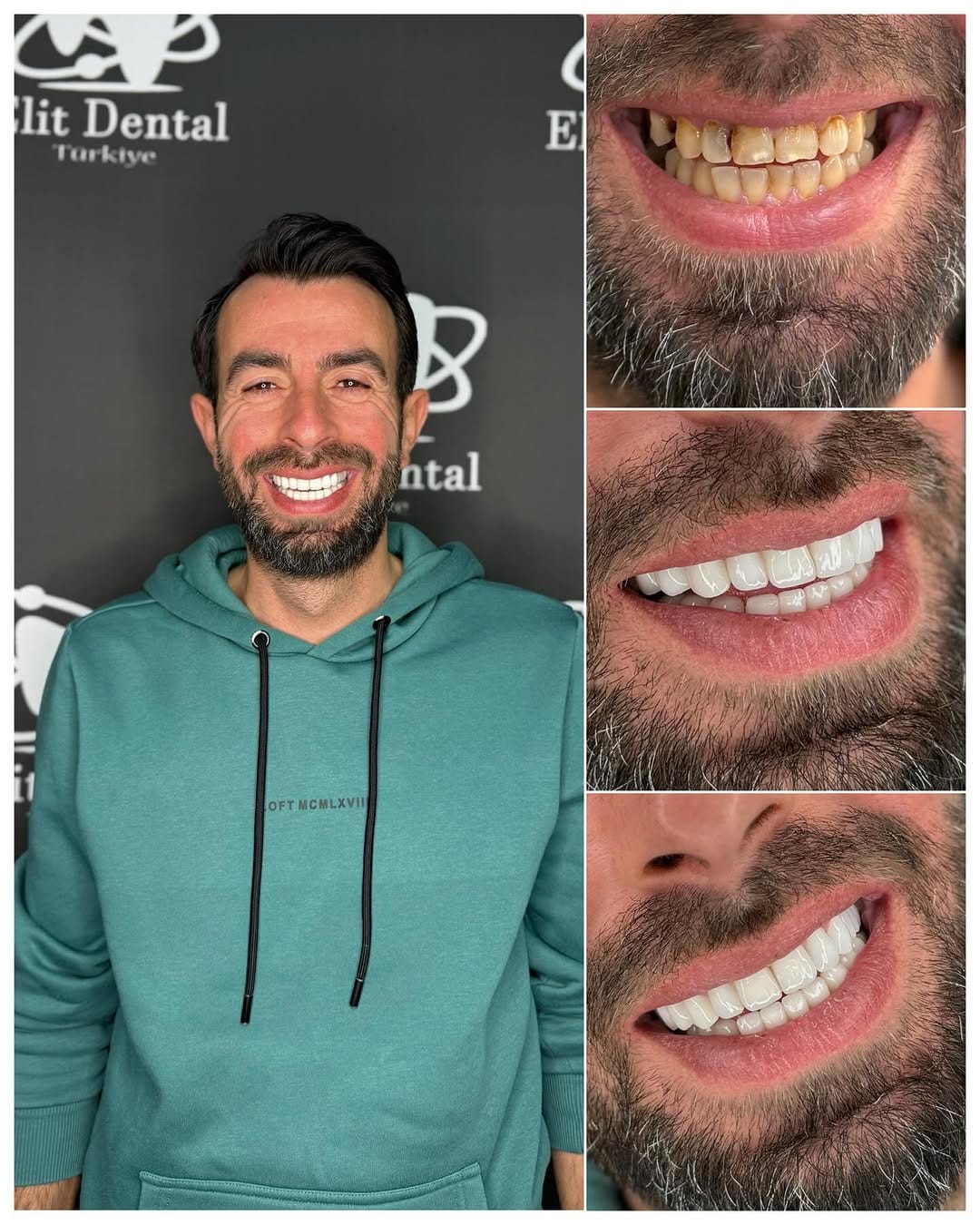 Post 8 by Elit Dental Türkiye on Instagram (image)