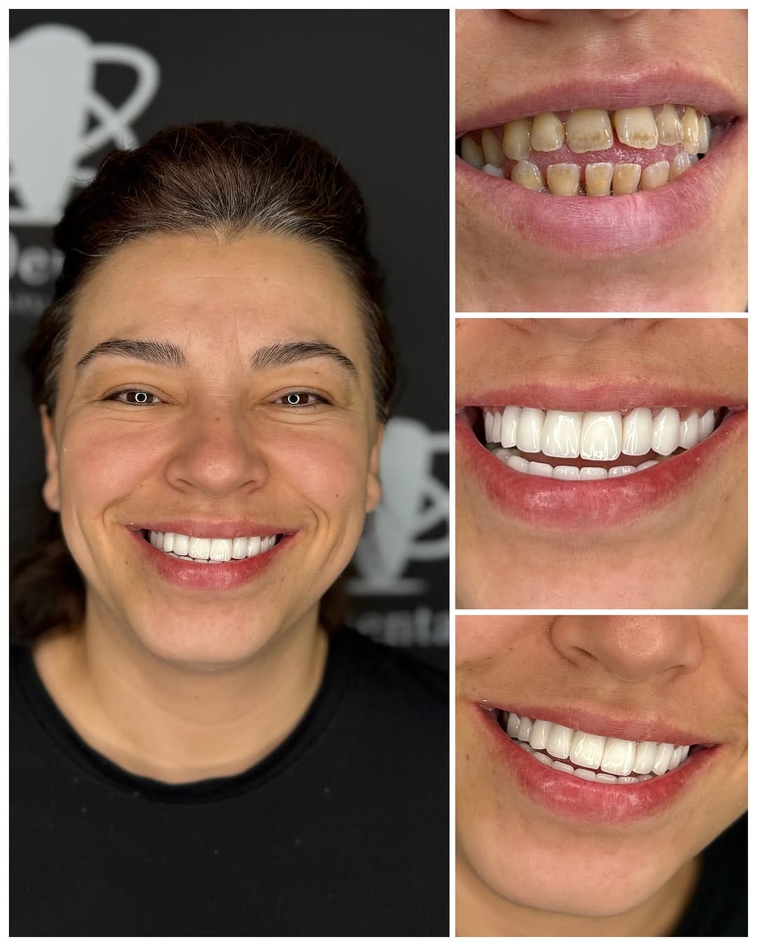 Post 9 by Elit Dental Türkiye on Instagram (image)