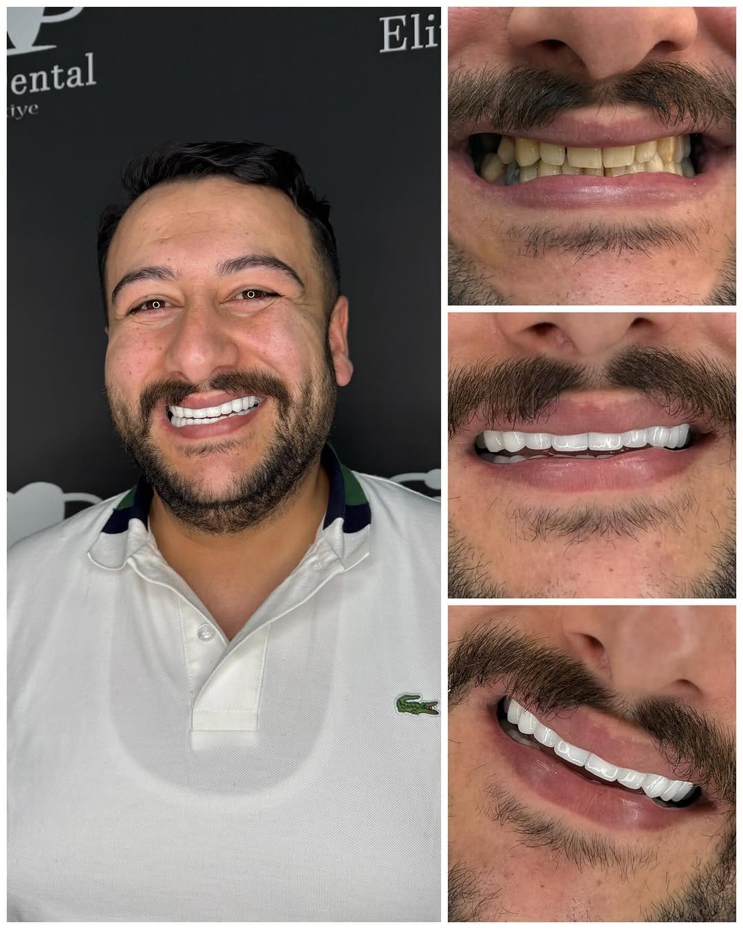 Post 2 by Elit Dental Türkiye on Instagram (image)
