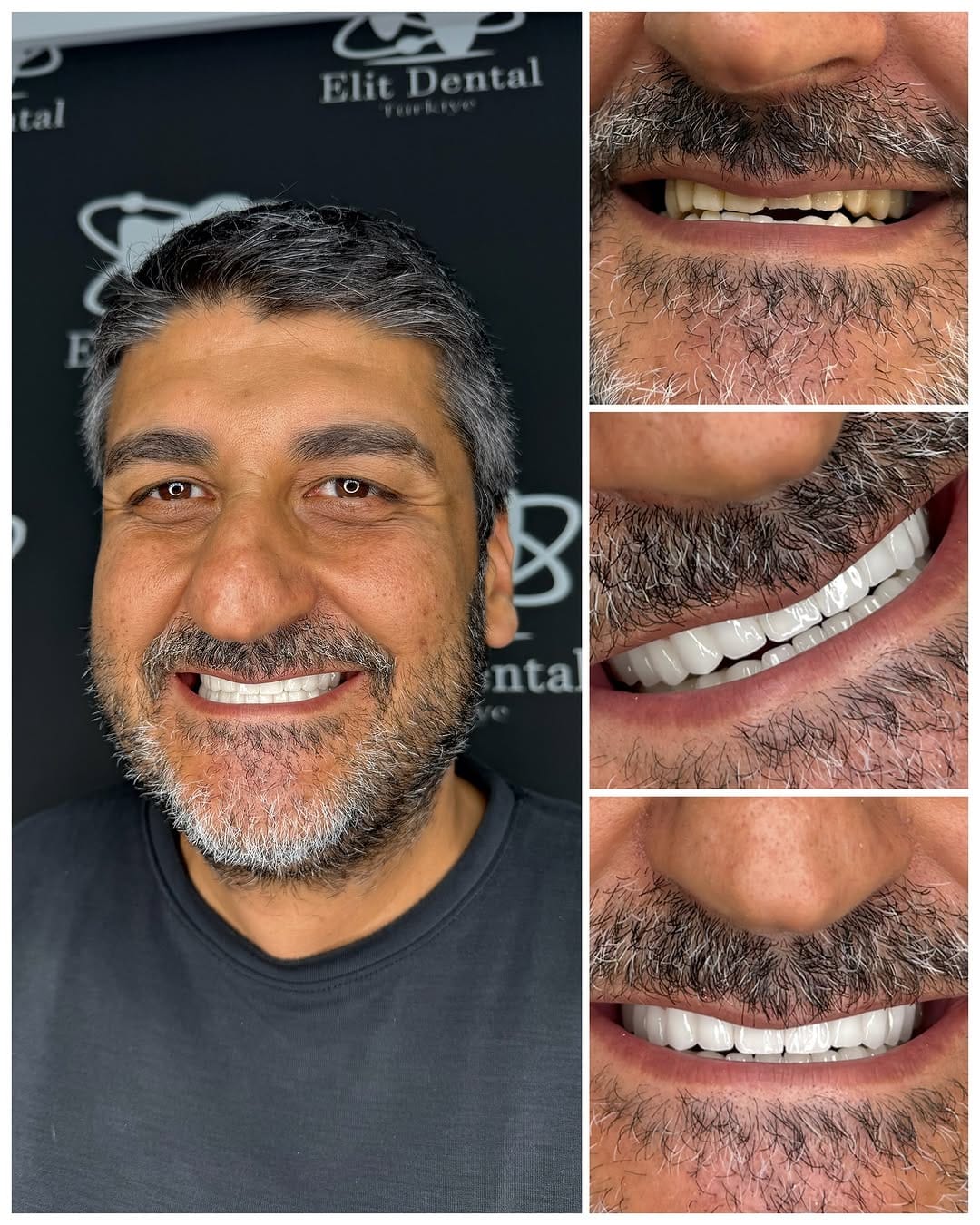 Post 10 by Elit Dental Türkiye on Instagram (image)