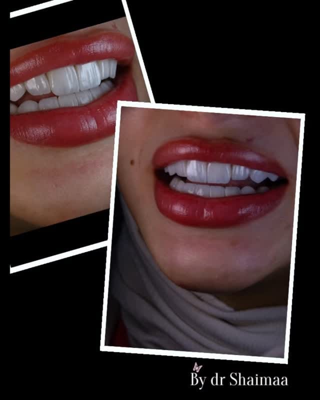 Post 4 by Dr Alshaimaa Alnaggar (Dentist Bahrain طبيبة اسنان البحرين ) on Instagram (video)