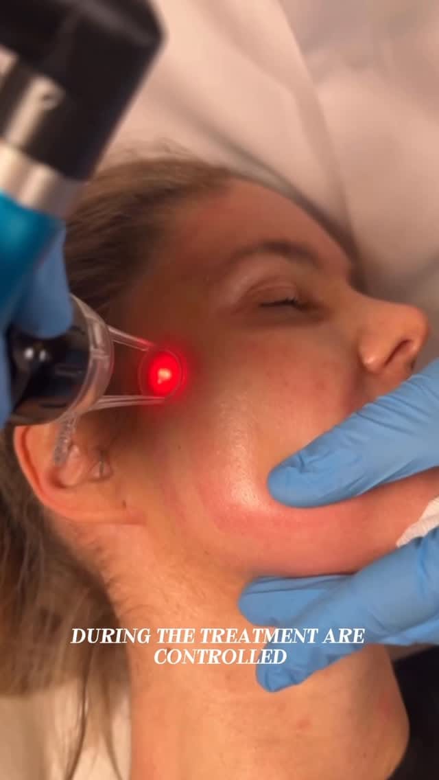 Post 6 by Hyaluron | Botox | Endolaser | CO2 Laser Berlin on Instagram (video)