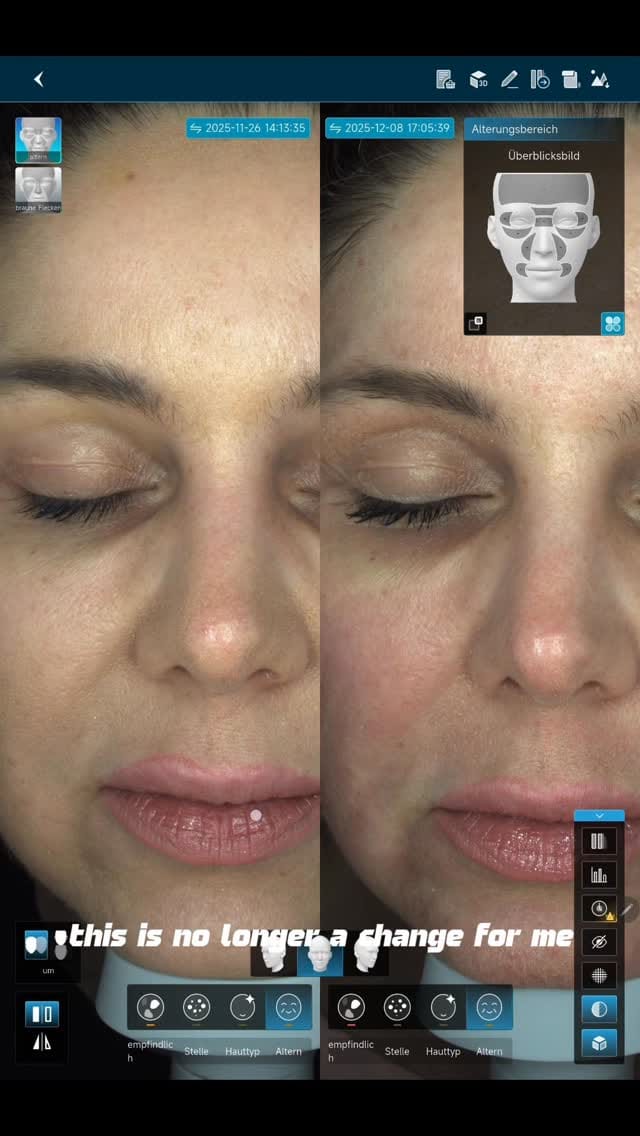 Post 8 by Hyaluron | Botox | Endolaser | CO2 Laser Berlin on Instagram (video)