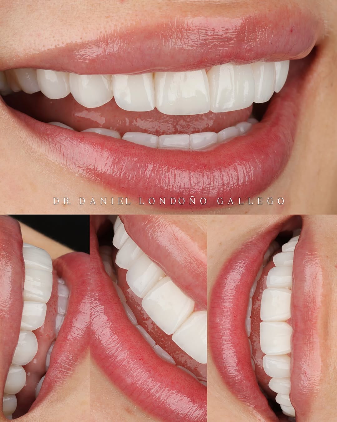 Post 3 by Dr. Daniel Londoño Gallego 🇨🇴 | Ceramic Veneers / SMILE DESIGN on Instagram (carousel)