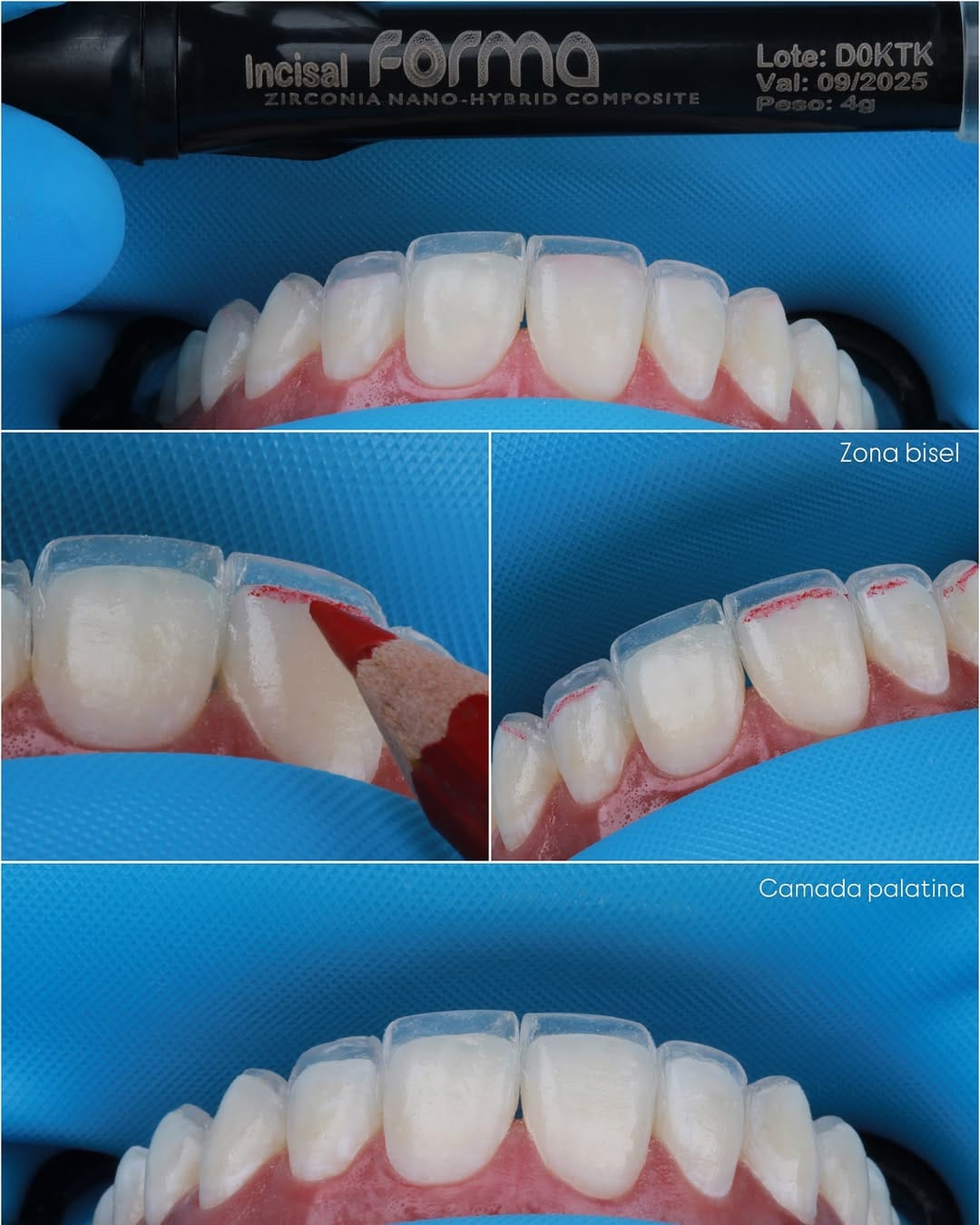 Post 9 by Dr. Daniel Londoño Gallego 🇨🇴 | Ceramic Veneers / SMILE DESIGN on Instagram (carousel)