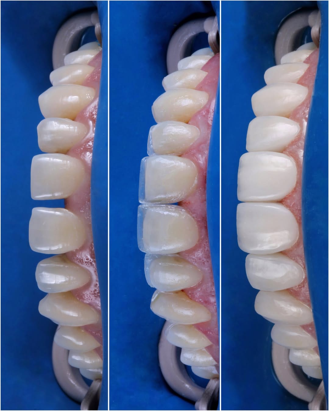 Post 6 by Dr. Daniel Londoño Gallego 🇨🇴 | Ceramic Veneers / SMILE DESIGN on Instagram (carousel)