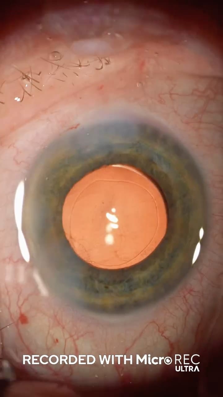 Post 3 by Custom Surgical on Instagram (video)