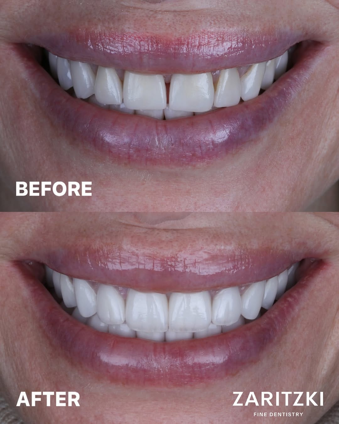 Post 6 by FELIX ZARITZKI FINE DENTISTRY on Instagram (carousel)