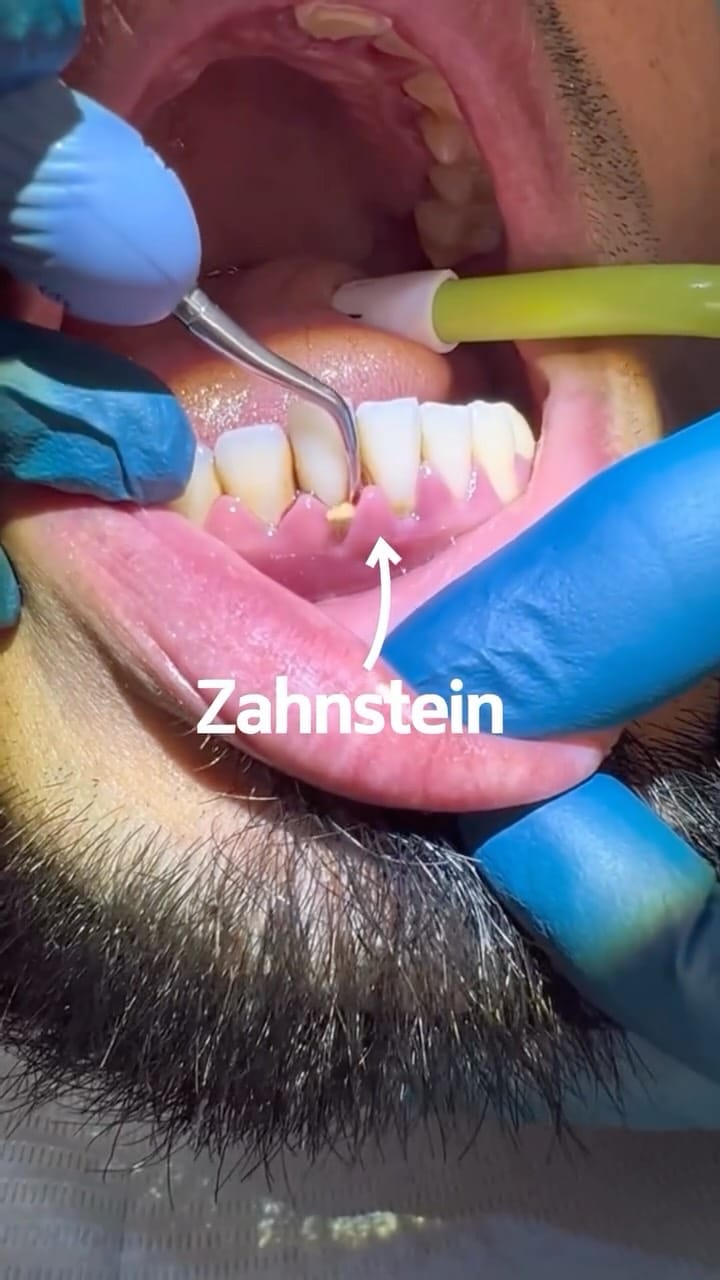 Post 8 by Adjmal Sheerzoi DDS MSc | Zahnarzt Düsseldorf on Instagram (video)