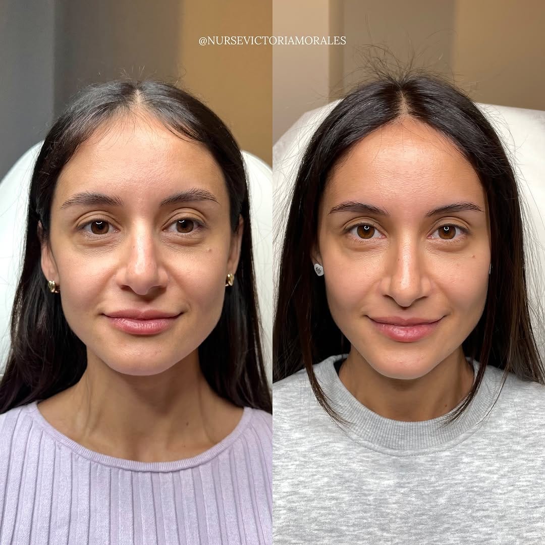 Post 8 by 𝐓𝐎𝐑𝐎𝐍𝐓𝐎 𝐂𝐎𝐒𝐌𝐄𝐓𝐈𝐂 𝐍𝐔𝐑𝐒𝐄💉 on Instagram (carousel)