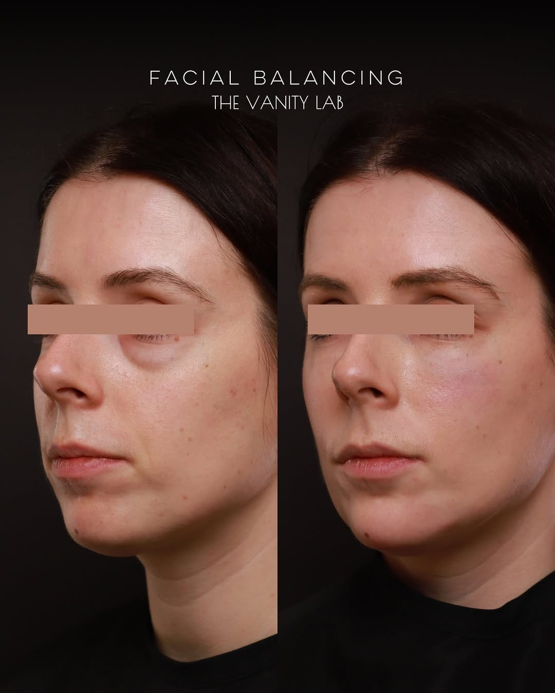 Post 7 by The Vanity Lab • Award Winning Medical Aesthetics on Instagram (carousel)
