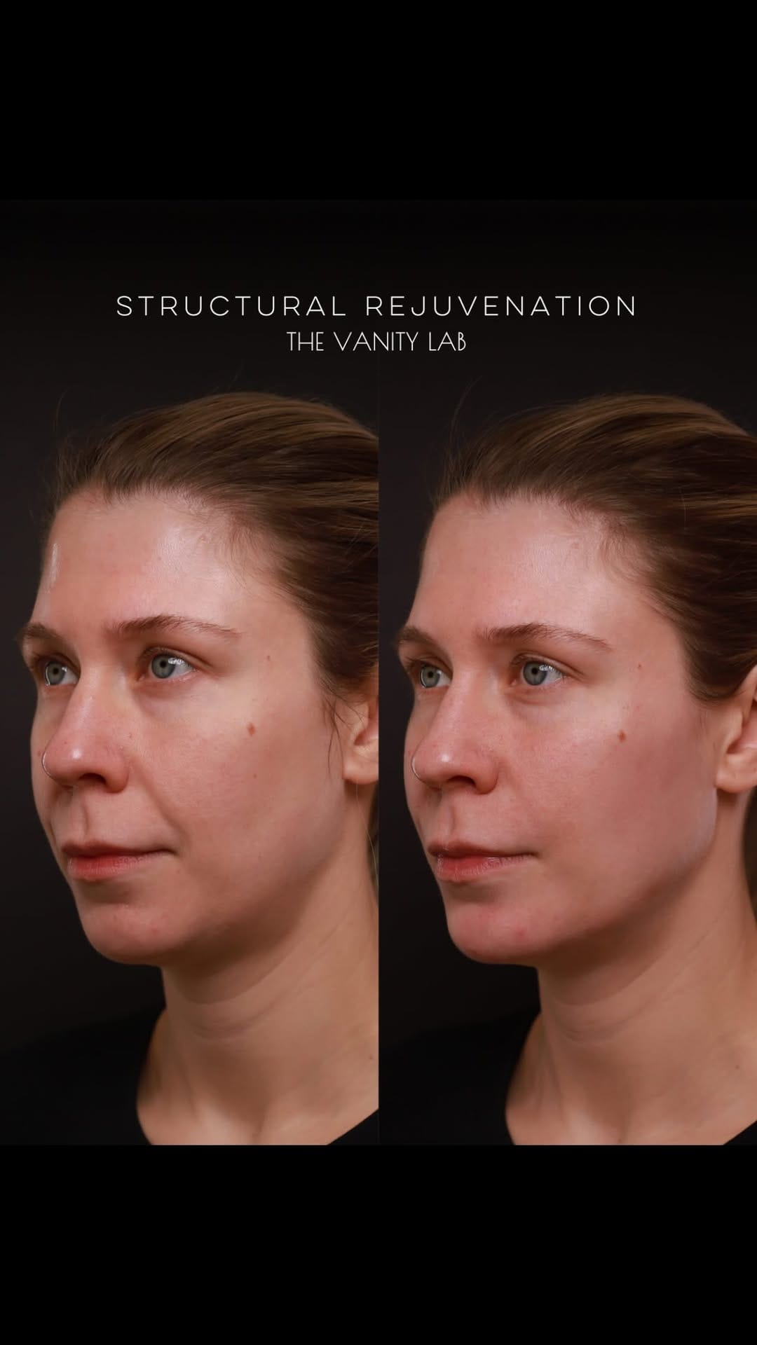 Post 6 by The Vanity Lab • Award Winning Medical Aesthetics on Instagram (video)